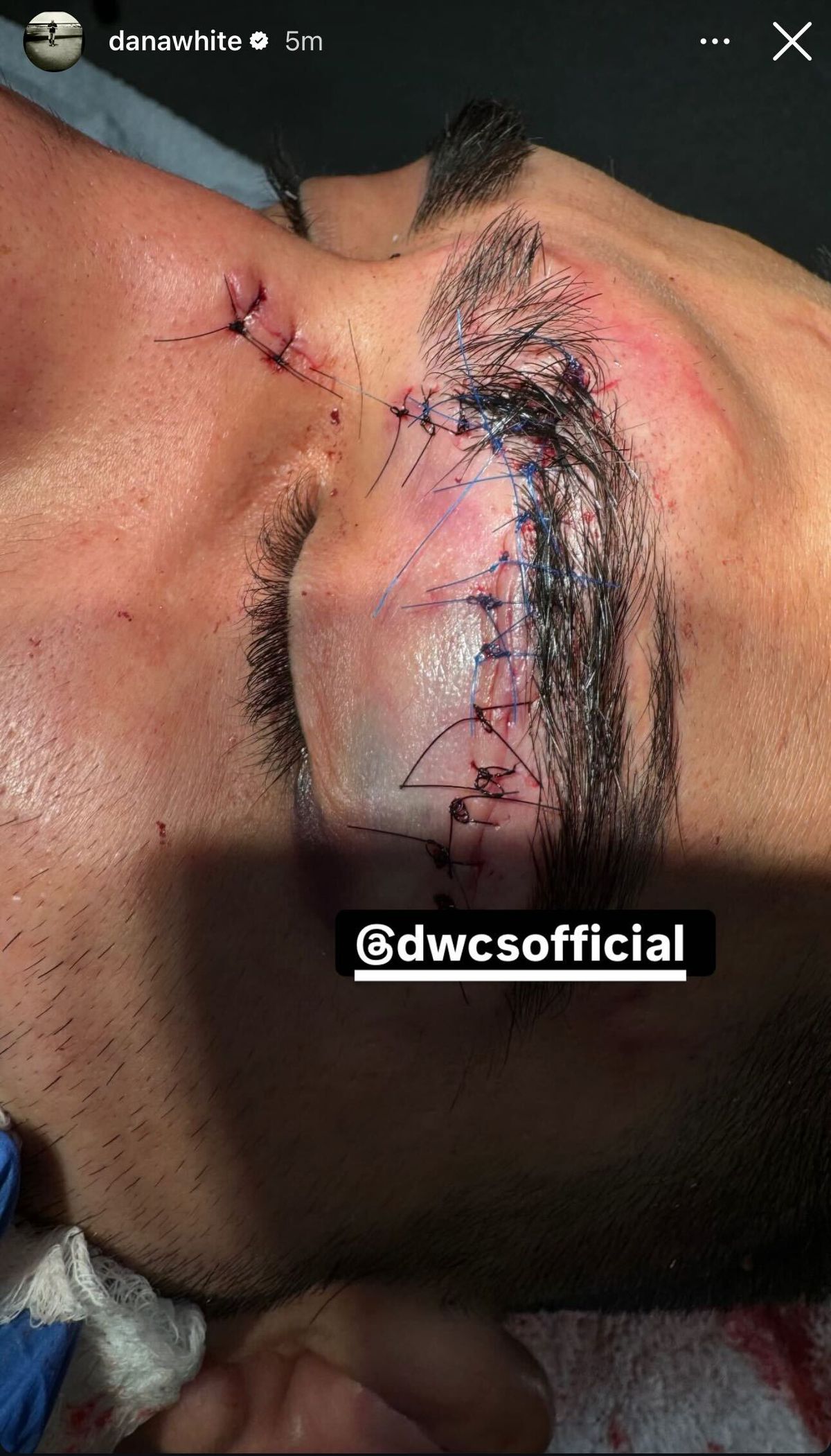 Revelado el espantoso corte que sufrió Michael Aswell en Contender Series