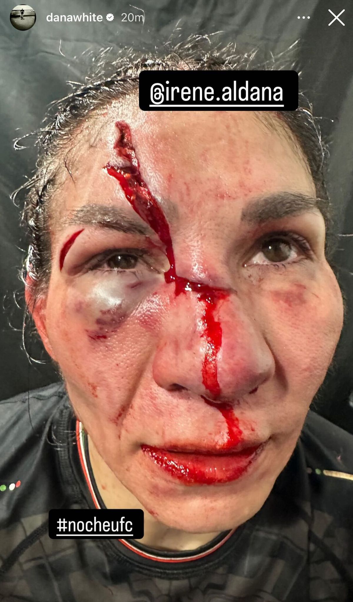 Video: Irene Aldana sufre horrible corte en la frente durante derrota ante Norma Dumont en UFC 306