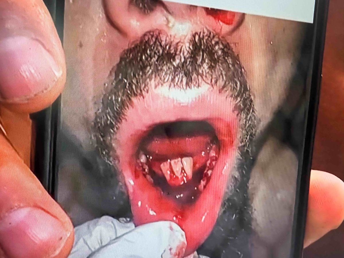 La foto de UFC 308 detalla la mandíbula destrozada de Robert Whittaker y los dientes de la sumisión de Khamzat Chimaev