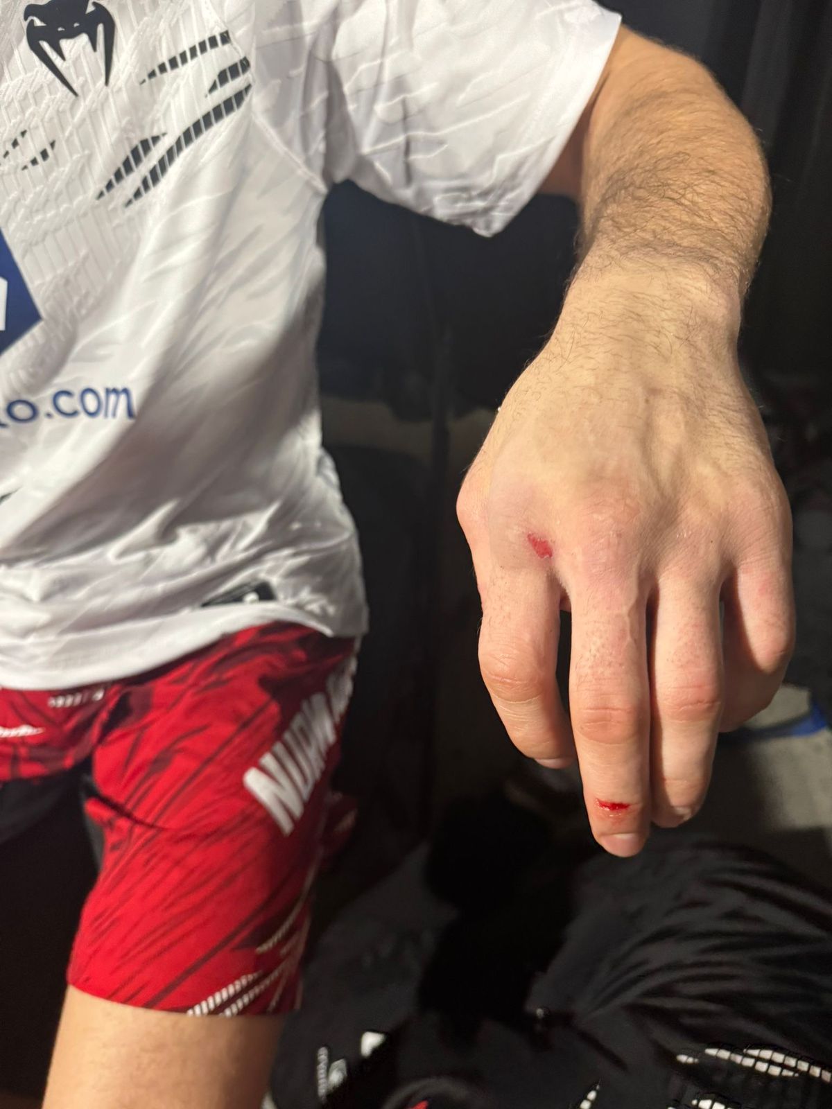 Umar Nurmagomedov sufrió una fractura en la mano en el primer asalto de UFC 311 pero "no creo que pierda esta pelea"